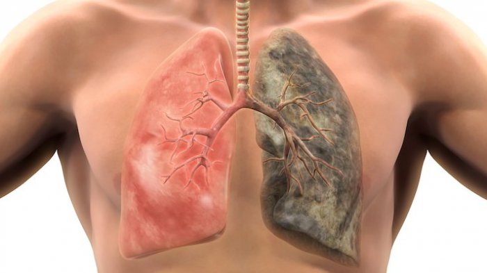 Gejala, Penyebab, Dan Cara Mengobati Orang Yang Terkena Kanker Paru-paru
